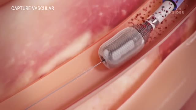 How this devise safely Removes blood clots || tech insider