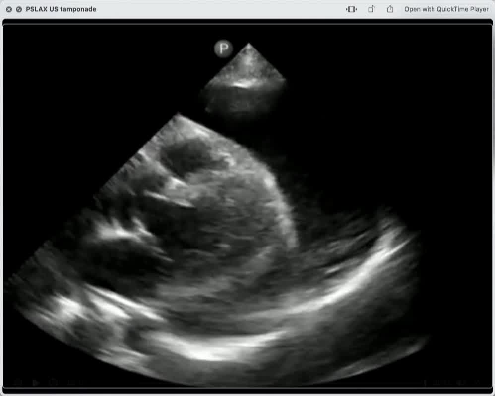 PSLX Ultrasound