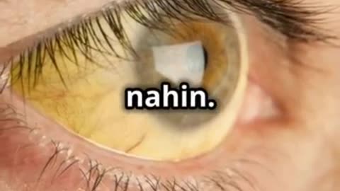 Jaundice disease treatment