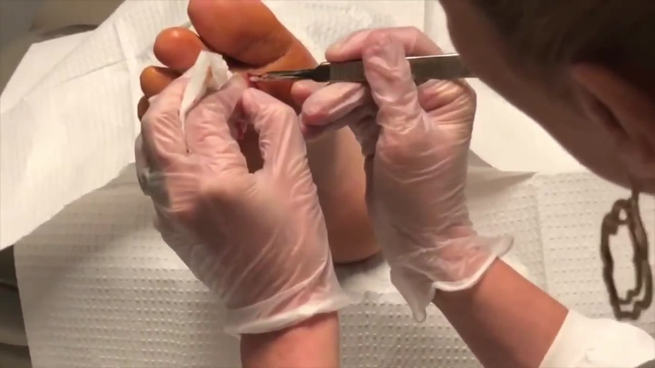 Draining Abscess From Foot