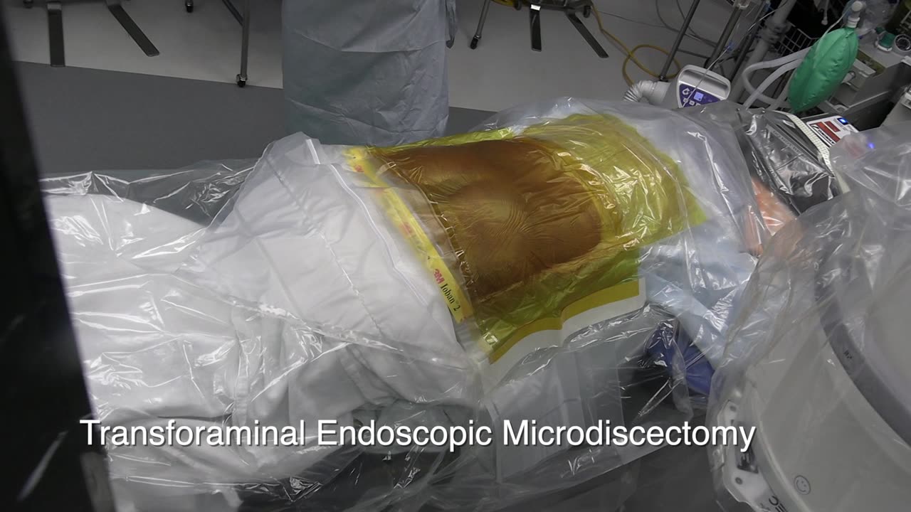 Transforaminal Endoscopic Microdiscectomy