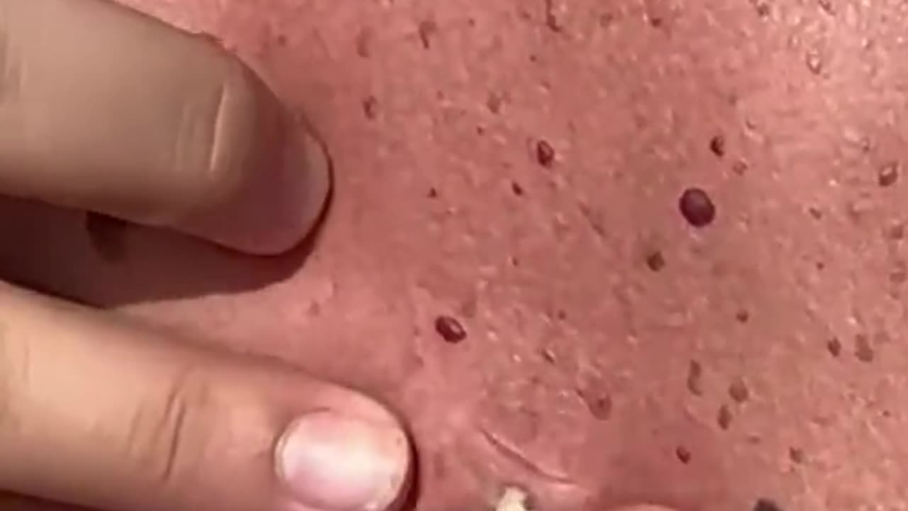 Big blackhead