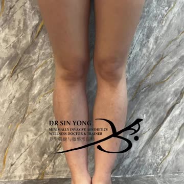 What Is 4K Body Lift?