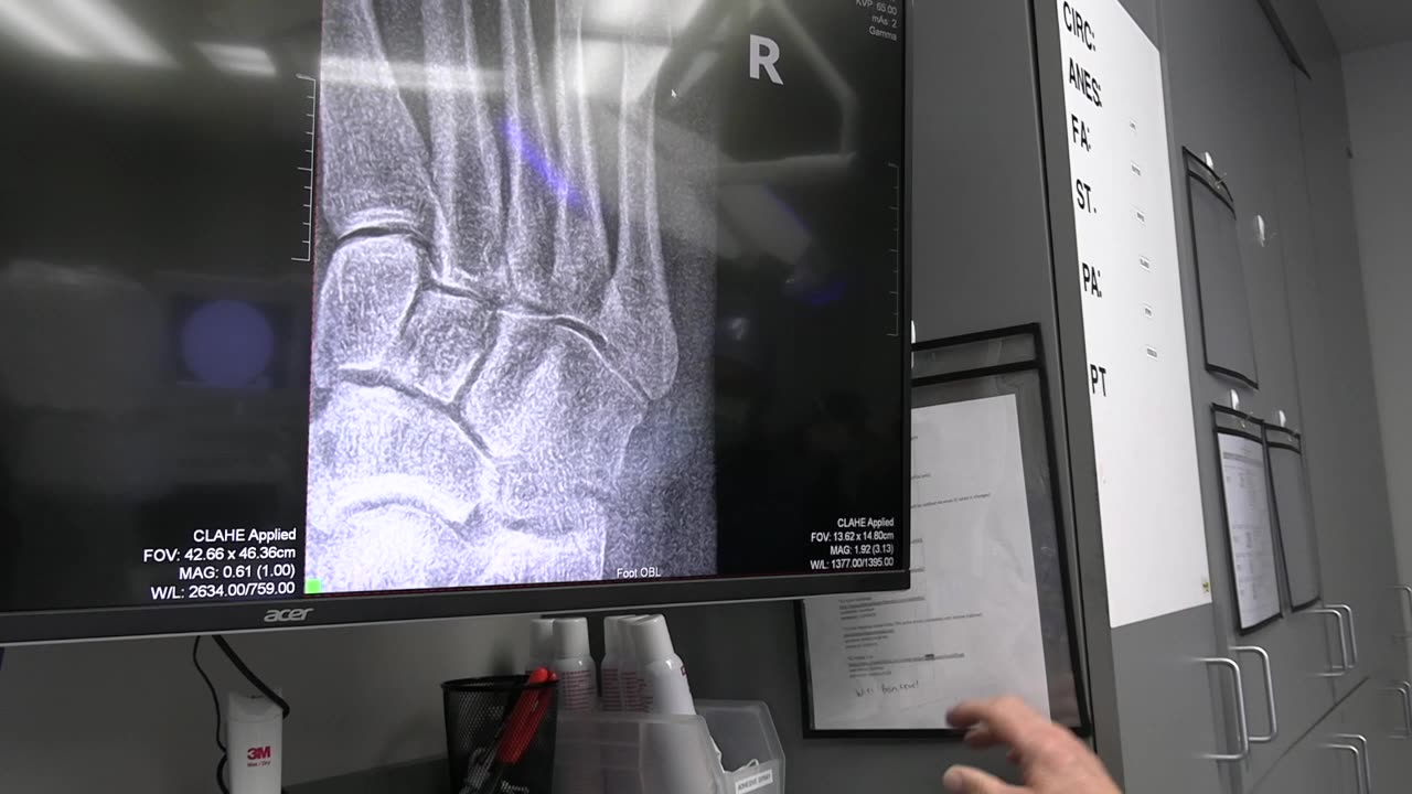 JONES FRACTURE