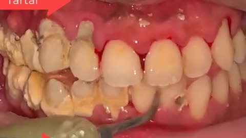 Tartar Dentist 2021 | Satisfying Dental-work