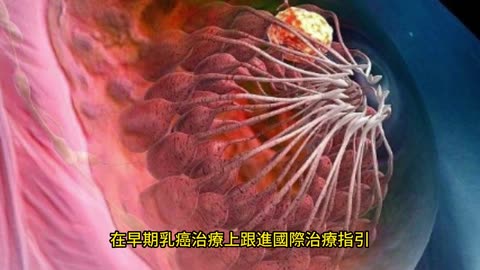 荷爾蒙陽性早期乳癌 有2～3成復發風險