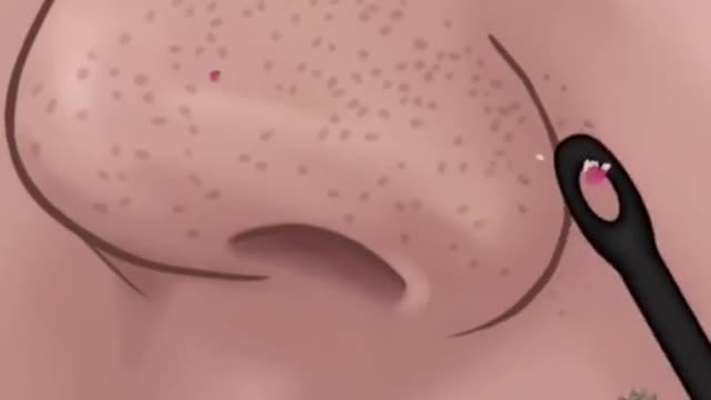 Satisfying Relaxing- Blackhead Removal