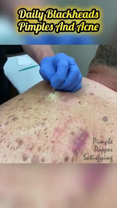 Cystic Acne Removal & Inflammatory Acne (1)