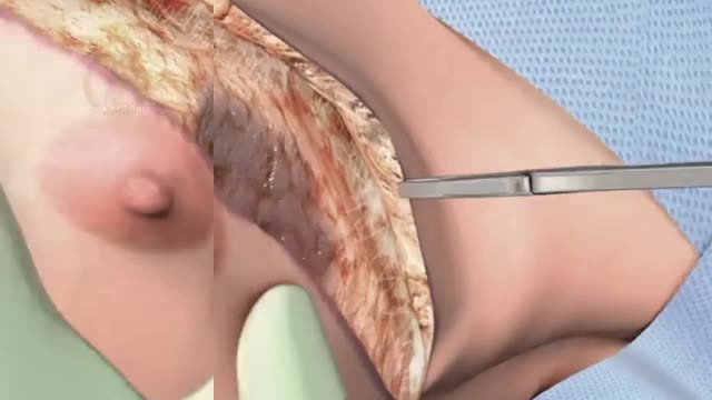 Breast operation procedure.