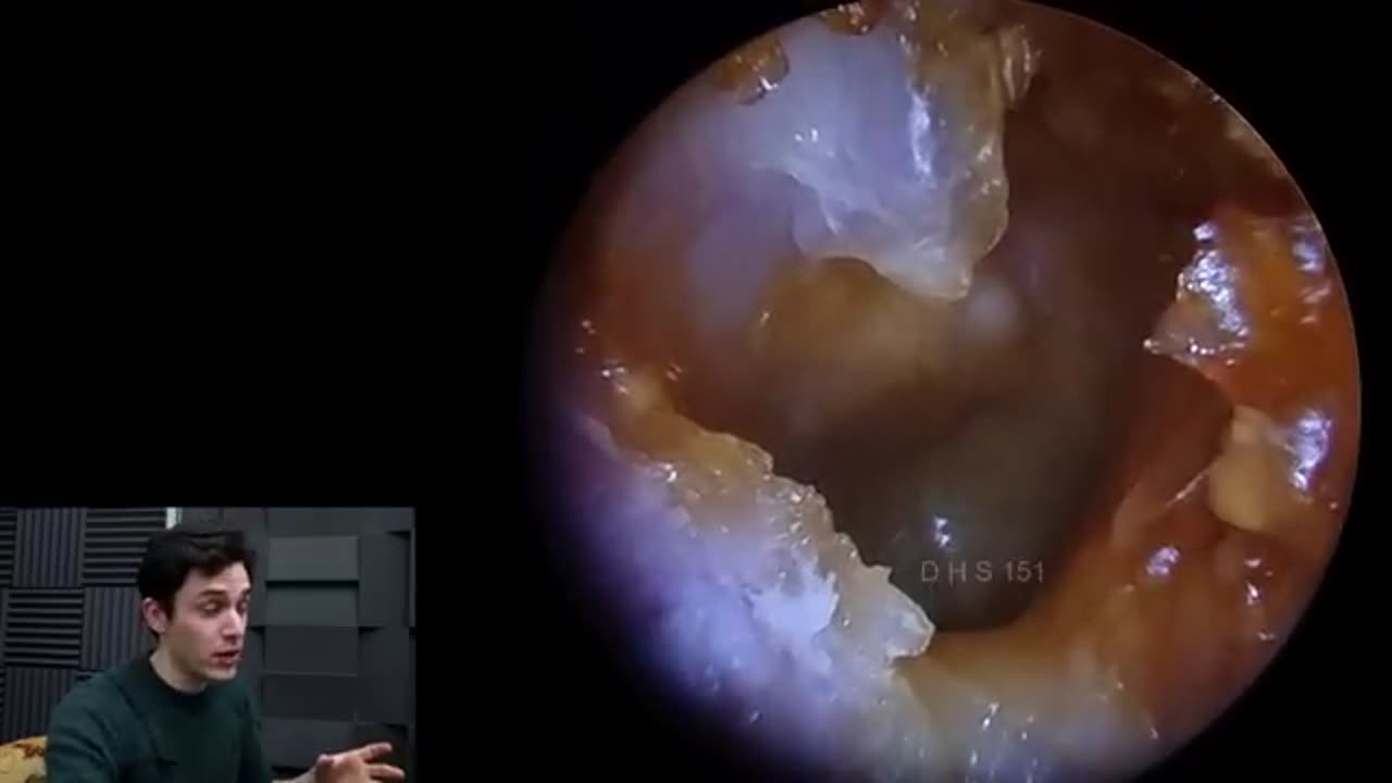 Ear_Canal_Bone_Eroding_(Canal_Cholesteatoma)