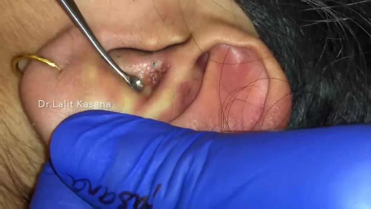 Blackheads in Ear