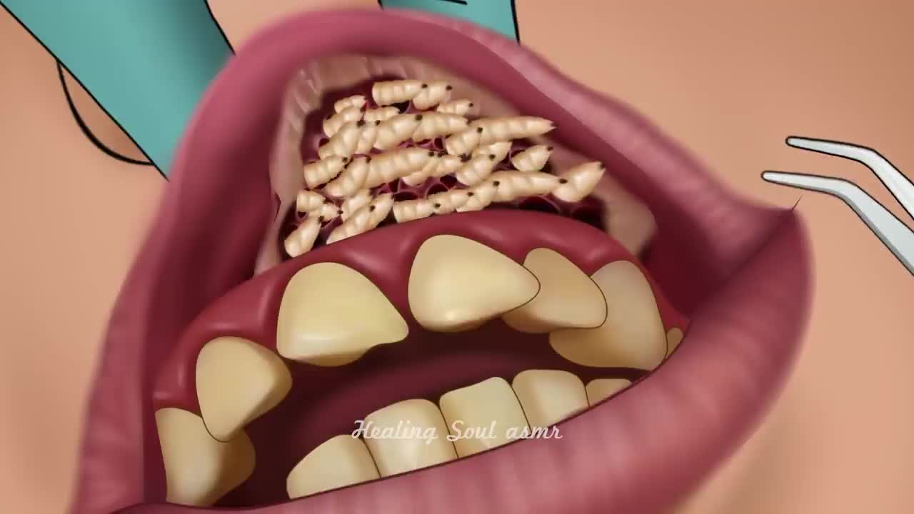 ASMR Remove botfly maggots found inside mountaineer's mouth | Dental care animation