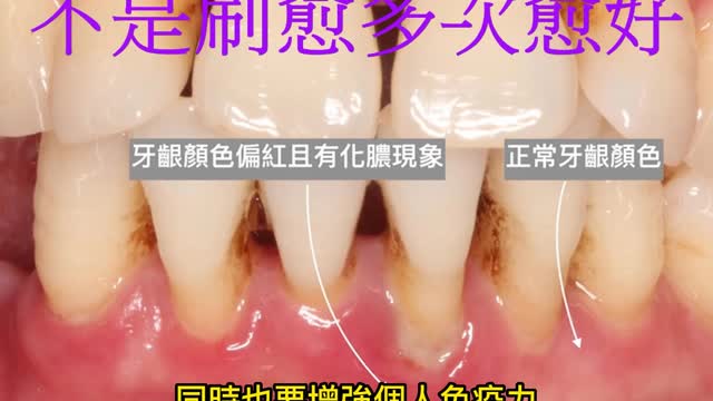 牙周病警訊! 不是刷愈多次愈好