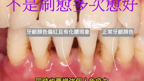 牙周病警訊！ 不是刷愈多次愈好
