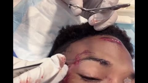 Shamar getting stitched up.
