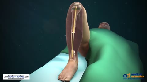 Tibial bone transport to make fractured bone fix itself