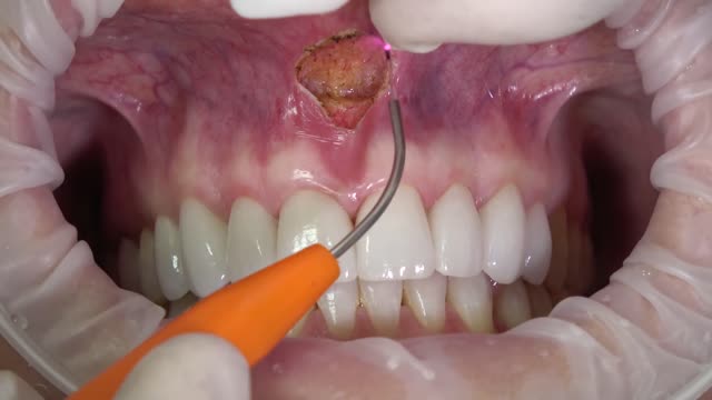 Frenectomy Procedure with Laser