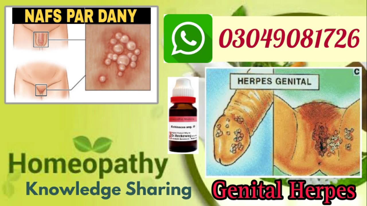 Genital herpes | Causes, Symptoms, homeopathic medicine for genital herpes | Dr.Abdul Manan