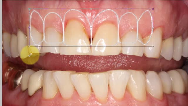 Using Photoshop to Design Smile Using Golden Proportion Template
