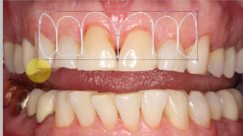 Using Photoshop to Design Smile Using Golden Proportion Template