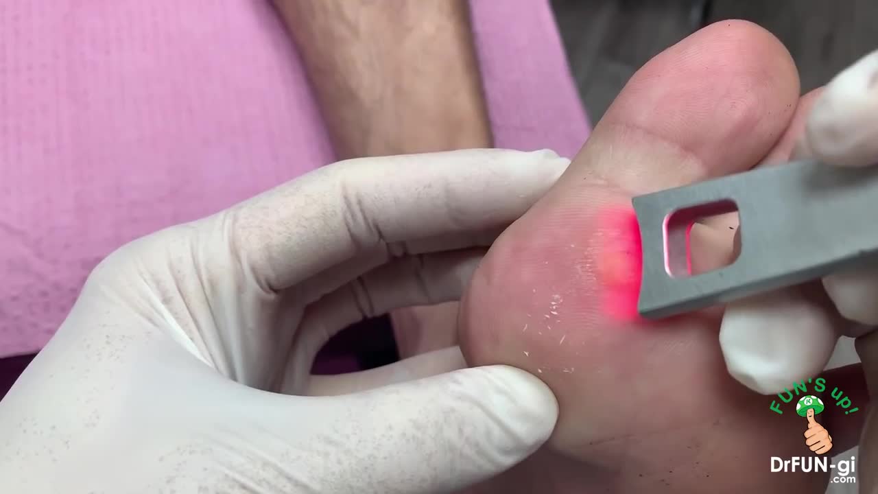 DEEP WART REMOVAL SATISFYING