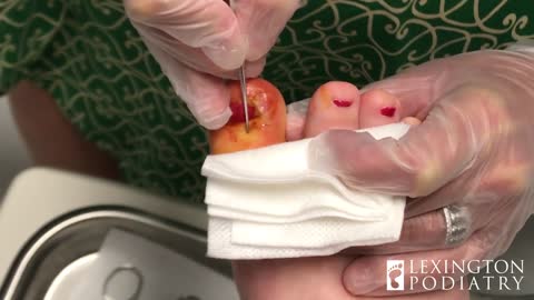 Ingrown Toenail Removal