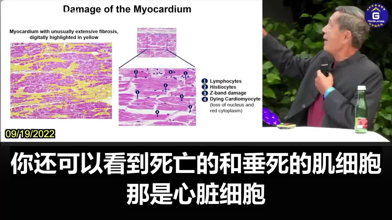 德國微生物學家Dr. Sucharit Bhakdi展示疫苗接種後,刺突蛋白對於心臟所造成的無法挽回的傷害!
