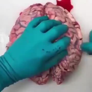 thrombosis in brain after vaccination
