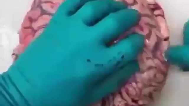 thrombosis in brain after vaccination