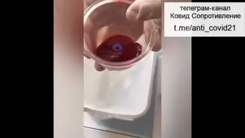 Chinese "cupping" removal of COVID Vaccine.