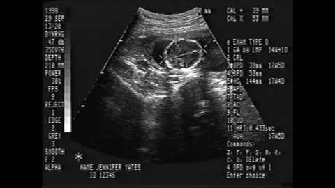 Dylan Ultrasound