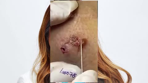 dr pimple popper blackhead