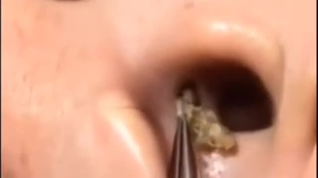 Acne Treatment 2022#Technicalexpertguru