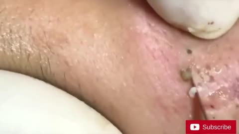 Satisfying Blackheads