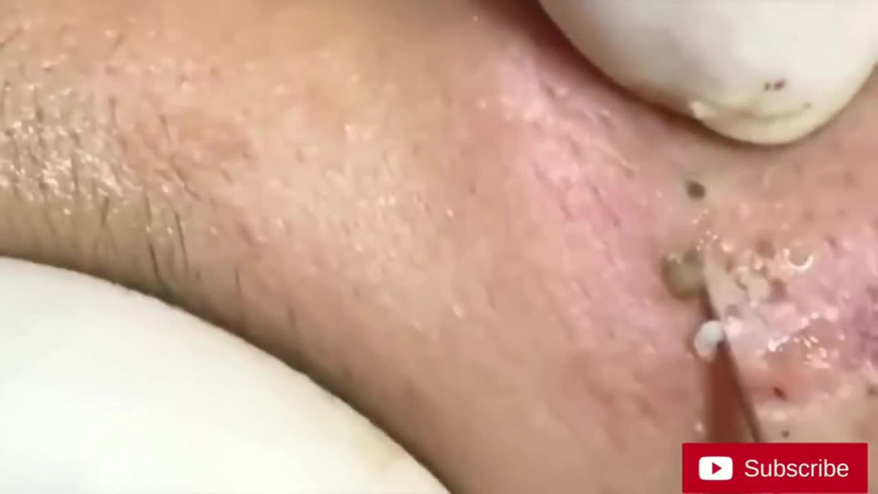 Satisfying Blackheads