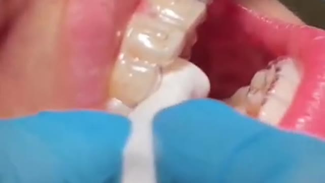 Teeth Treatment