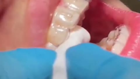 Teeth Treatment