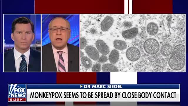 A "rare" disease called monkeypox has been spreading all over the world.