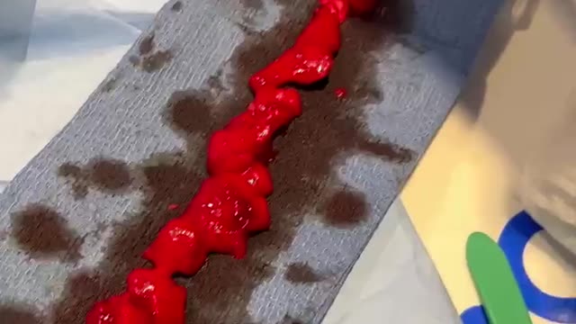 This video was taken by a heart surgeon on a 40 year old vaccinated athlete...