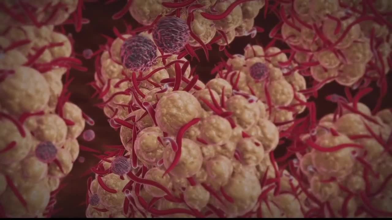 Woman among monkeypox patients in Georgia