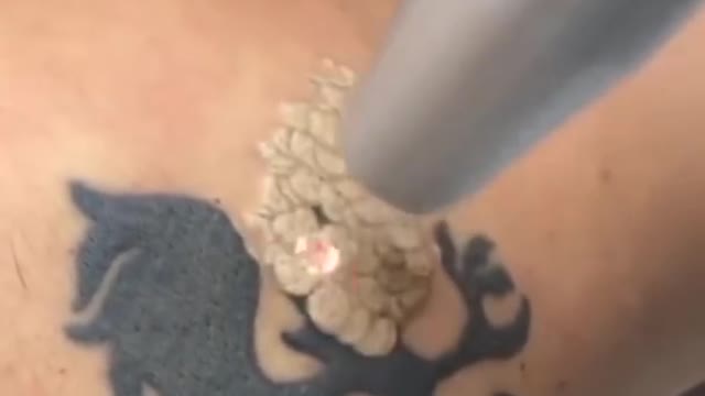 Satisfying Tattoo Removal