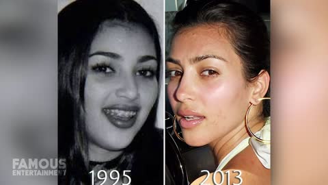 Kim K Before and after her surgerys