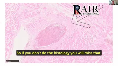 Physician Warns: Aggressive and Unusual Cancers following Covid 'Vaccination' are on the Rise
