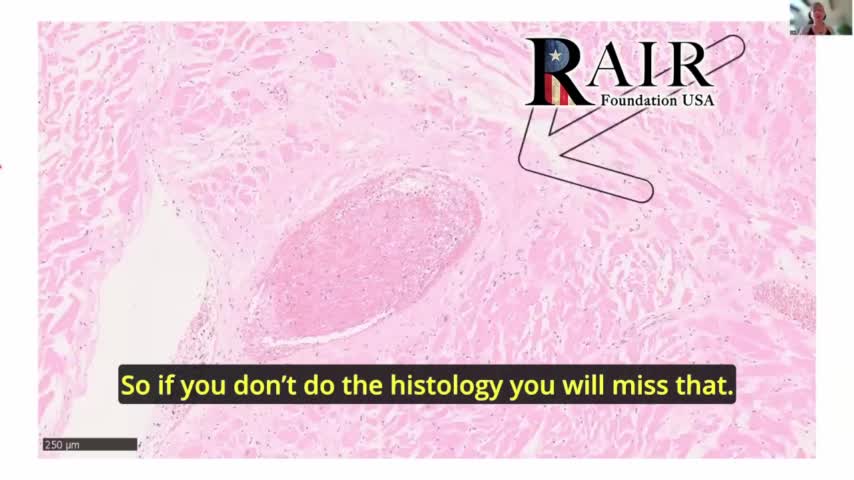 Physician Warns: Aggressive and Unusual Cancers following Covid 'Vaccination' are on the Rise