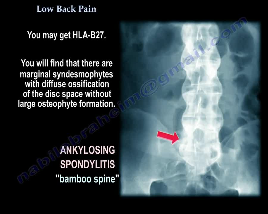 Low Back Pain - Everything You Need To Know - Dr. Nabil Ebraheim