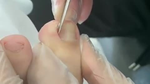 #ToenailroomB Big ingrown toenail removal👣OMG toenail podiatrist home treatment👣 #toenail #shorts