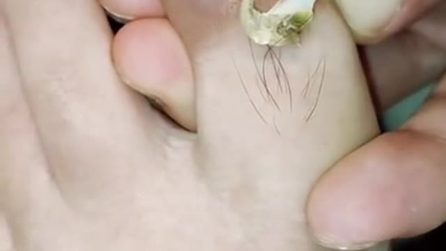 Big Ingrown Toenail Cutting shorts asmr DIY Pedicure removal nail tools foot 73