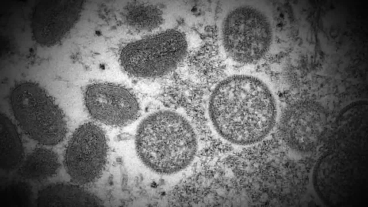 "U.S. declares monkeypox a health emergency "