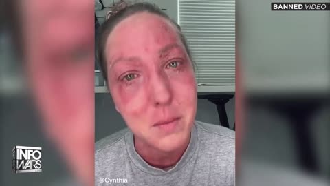 Woman Warns The World How Covid Vaccine Destroyed Her Life!