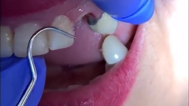 Extracting a broken tooth forcibly
